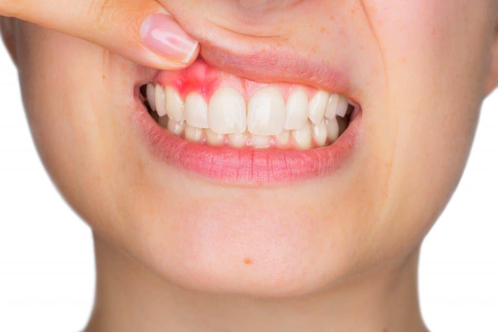 Povlačenje zubnog mesa